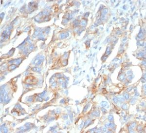 Formalin-fixed, paraffin-embedded human ovarian carcinoma stained with CD276 / B7-H3 Mouse Monoclonal Antibody (B7H3/4345) at 2ug/ml. HIER: Tris/EDTA, pH9.0, 45min. 2°C: HRP-polymer, 30min. DAB, 5min.