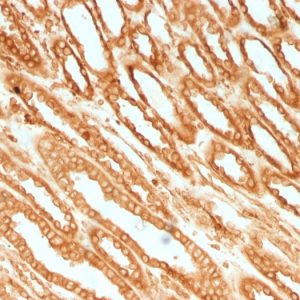 Formalin-fixed, paraffin-embedded human Renal Cell Carcinoma stained with Calnexin Mouse Monoclonal Antibody (CANX/1541).