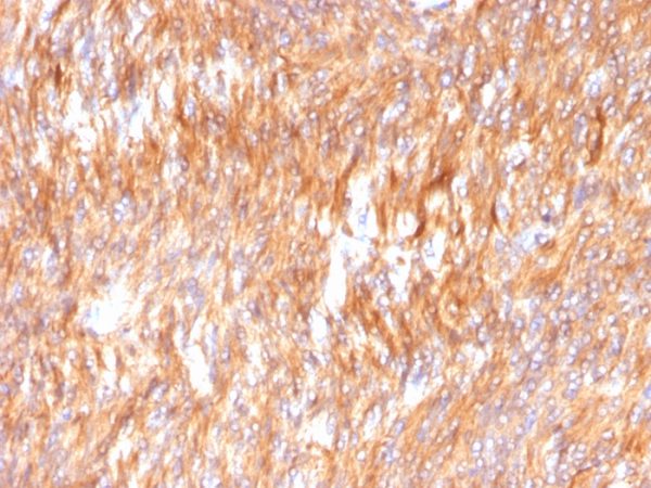 Formalin-fixed, paraffin-embedded human Small Intestinal Carcinoma stained with Calnexin Mouse Monoclonal Antibody (CANX/1541).