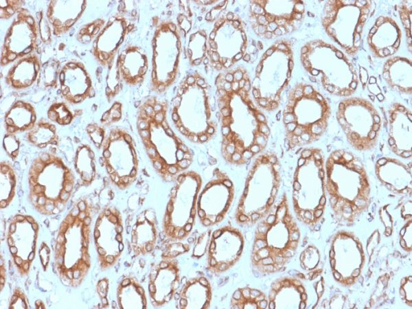 Formalin-fixed, paraffin-embedded human renal cell carcinoma stained with Calnexin Mouse Monoclonal Antibody (CANX/1543). HIER: Tris/EDTA, pH9.0, 45min. 2°C: HRP-polymer, 30min. DAB, 5min.
