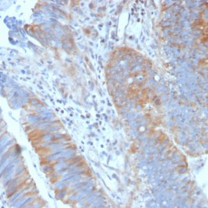 Formalin-fixed, paraffin-embedded human Colon Carcinoma stained with Calpain 1 Mouse Monoclonal Antibody (CAPN1/1530).