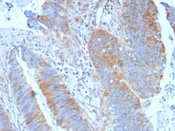 Formalin-fixed, paraffin-embedded human Colon Carcinoma stained with Calpain 1 Mouse Monoclonal Antibody (CAPN1/1530).