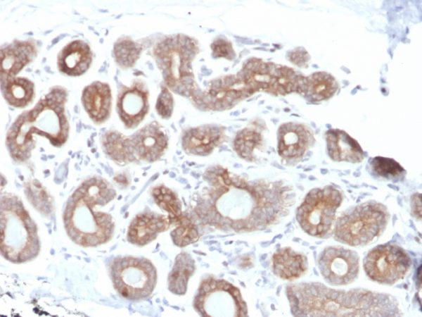 Formalin-fixed, paraffin-embedded human Breast Carcinoma stained with Calpain 1 Mouse Monoclonal Antibody (CAPN1/1530).