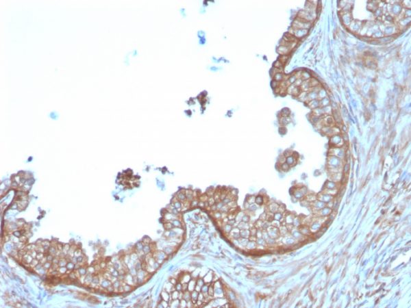 Formalin-fixed, paraffin-embedded human Prostate Carcinoma stained with Calpastatin Mouse Monoclonal Antibody (CAST/1550).