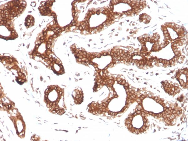 Formalin-fixed, paraffin-embedded human Breast Carcinoma stained with Calpastatin Mouse Monoclonal Antibody (CAST/1550).