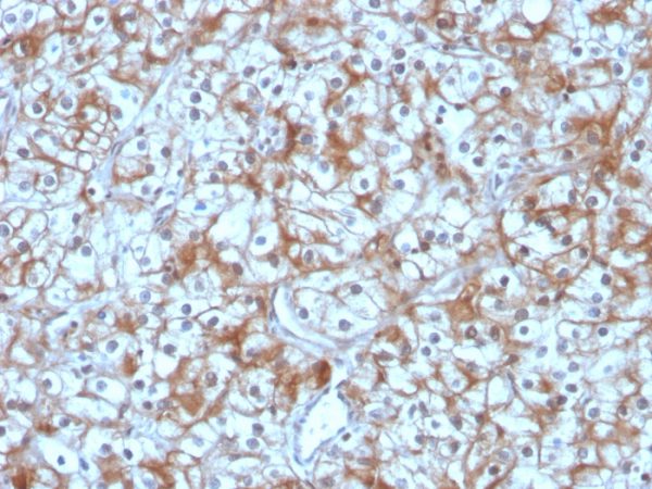 Formalin-fixed, paraffin-embedded human Bladder Carcinoma stained with Calpastatin Mouse Monoclonal Antibody (CAST/1550).