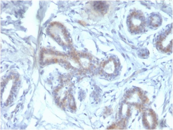 Formalin-fixed, paraffin-embedded human Breast carcinoma stained with BAP1 Mouse Monoclonal Antibody (BAP1/2433).