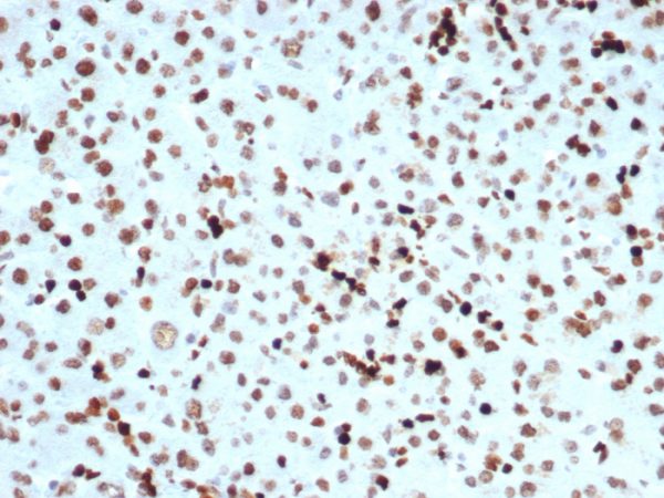 Formalin-fixed, paraffin-embedded human liver carcinoma in colon stained with Histone H3 (PHH3) Recombinant Rabbit Monoclonal Antibody (PHH3/471R).