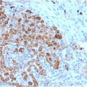 Formalin-fixed, paraffin-embeddedhuman lymph node stained with TIM3 Mouse Monoclonal Antibody (TIM3/4025).