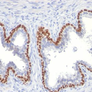 Formalin-fixed, paraffin-embedded human Prostate Cancer stained with p63 Mouse Monoclonal Antibody (TP63/11).