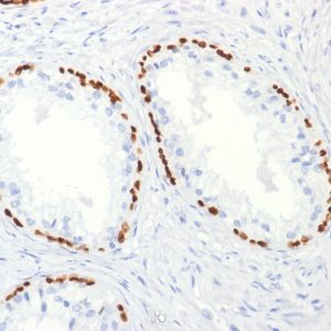 Formalin-fixed, paraffin-embedded human Prostate Carcinoma stained with p63 Mouse Monoclonal Antibody (TP63/2427).