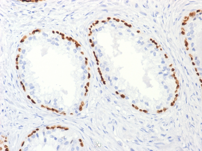 Formalin-fixed, paraffin-embedded human Prostate Carcinoma stained with p63 Mouse Monoclonal Antibody (TP63/2427). p63 (Squamous, Basal & Myoepithelial Cell Marker) Antibody