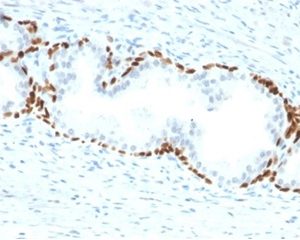 Formalin-fixed, paraffin-embedded human prostate carcinoma stained with p63 Mouse Monoclonal Antibody (TP63/2428).