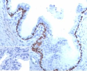 Formalin-fixed, paraffin-embedded human prostate cancer stained with p63 Recombinant Rabbit Monoclonal Antibody (TP63/4379R). Inset: PBS instead of primary antibody, secondary antibody negative control.