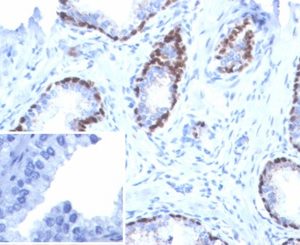Formalin-fixed, paraffin-embedded human prostate cancer stained with p40 Recombinant Rabbit Monoclonal Antibody (P40/7302R). Inset: PBS instead of primary antibody, secondary antibody negative control.