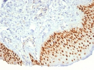 Formalin-fixed, paraffin-embedded human prostate cancer stained with p40 Recombinant Rabbit Monoclonal Antibody (P40/7302R). HIER: Tris/EDTA, pH9.0, 45min. 2 °: HRP-polymer, 30min. DAB, 5min.