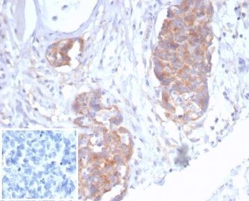 Formalin-fixed, paraffin-embedded human ovarian cancer stained with p40 Recombinant Rabbit Monoclonal Antibody (P40/7302R). Inset: PBS instead of primary antibody; secondary only negative control.