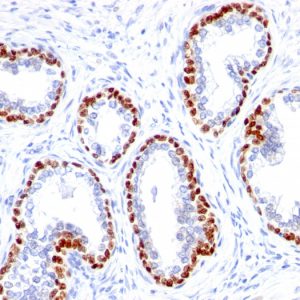 Formalin-fixed, paraffin-embedded human Prostate Cancer stained with p63 Rabbit Monoclonal Antibody (TP63/1423R).