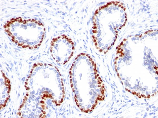 Formalin-fixed, paraffin-embedded human Prostate Cancer stained with p63 Rabbit Monoclonal Antibody (TP63/1423R).
