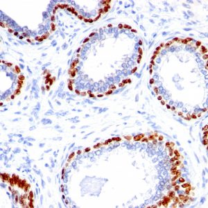 Formalin-fixed, paraffin-embedded human Prostate Carcinoma stained with p40 Rabbit Polyclonal Antibody.