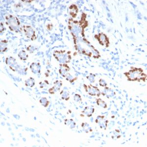 Formalin-fixed, paraffin-embedded human Breast Carcinoma stained with p40 Rabbit Polyclonal Antibody.