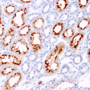 Formalin-fixed, paraffin-embedded human Renal Cell Carcinoma stained with CD137L-Monospecific Mouse Monoclonal Antibody (CD137L/1547).
