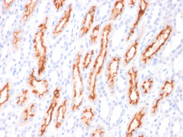 Formalin-fixed, paraffin-embedded human Renal Cell Carcinoma stained with CD137L-Monospecific Mouse Monoclonal Antibody (CD137L/1547).