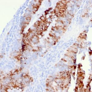 Formalin-fixed, paraffin-embedded human colon carcinoma stained with DR5 Mouse Monoclonal Antibody (DR5/3381).