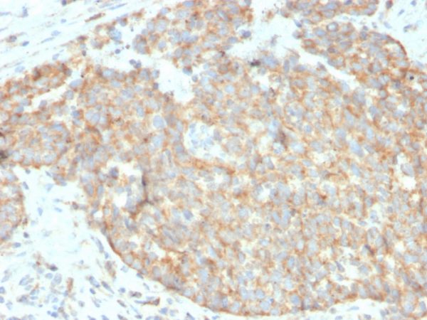 Formalin-fixed, paraffin-embedded human breast carcinoma stained with DR5 Mouse Monoclonal Antibody (DR5/3381).
