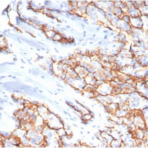 Formalin-fixed, paraffin-embedded human papillary renal cell carcinoma stained with CD133 / Prominin Mouse Monoclonal Antibody (PROM/6316).