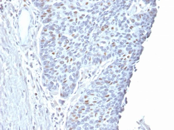 Formalin-fixed, paraffin-embedded human Endometrial Carcinoma stained with Cyclin A2 Mouse Monoclonal Antibody (CCNA2/2333).