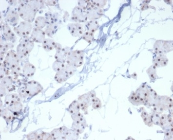 Formalin-fixed, paraffin-embedded human renal cell carcinoma stained with PHOX2B Recombinant Rabbit Monoclonal Antibody (PHOX2B/7161R). HIER: Tris/EDTA, pH9.0, 45min. 2°C: HRP-polymer, 30min. DAB, 5min.