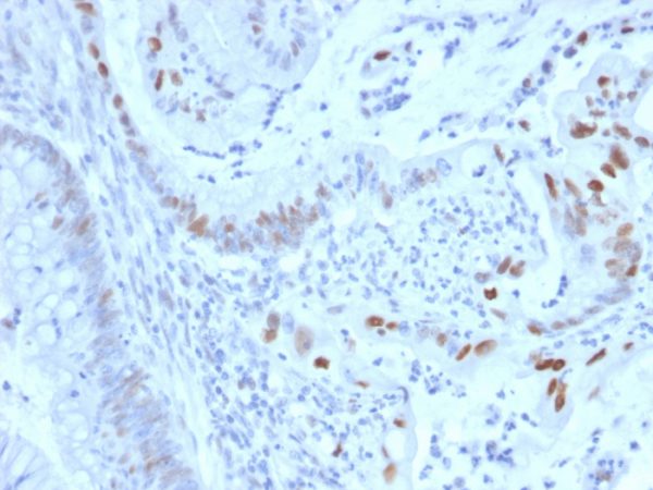 Formalin-fixed, paraffin-embedded human colon carcinoma stained with Cyclin E Mouse Monoclonal Antibody (CCNE1/2460).