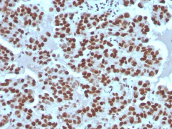 Formalin-fixed, paraffin-embedded human breast carcinoma stained with Cyclin E Recombinant Mouse Monoclonal Antibody (rCCNE1/4936).