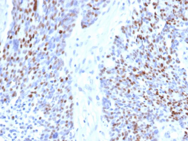 Formalin-fixed, paraffin-embedded human ovarian carcinoma stained with Cyclin E Recombinant Mouse Monoclonal Antibody (rCCNE1/4936).