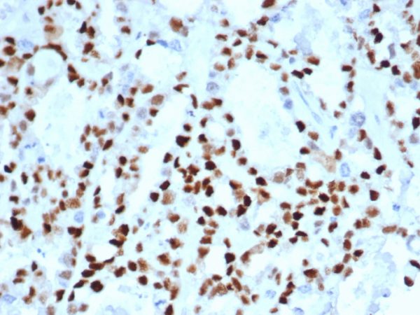 Formalin-fixed, paraffin-embedded human ovarian carcinoma stained with Cyclin E Recombinant Rabbit Monoclonal Antibody (CCNE1/4935R).