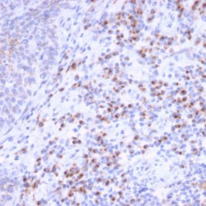 Formalin-fixed, paraffin-embedded human Unknown Tumor stained with RCAS1 Mouse Monoclonal Antibody (CPTC-EBAG9-1).