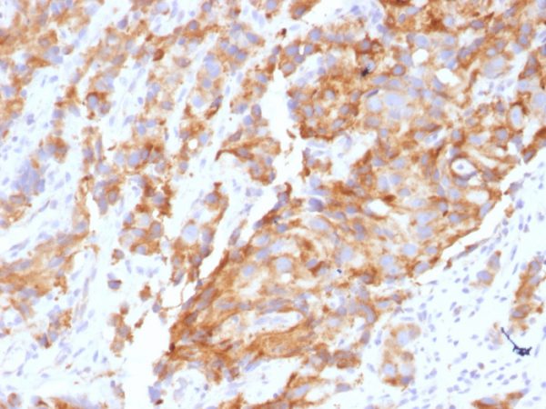 Formalin-fixed, paraffin-embedded human Prostate Carcinoma stained with Aurora B Mouse Monoclonal Antibody (AURKB/1592).