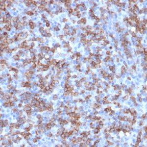 Formalin-fixed, paraffin-embedded human Lymphoma stained with CD8a Rabbit Recombinant Monoclonal Antibody (C8/1779R).