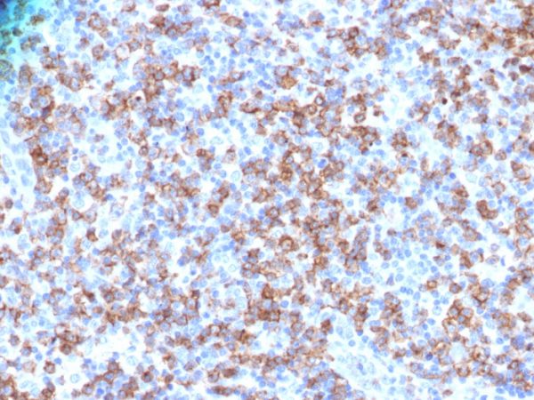 Formalin-fixed, paraffin-embedded human Lymphoma stained with CD8a Rabbit Polyclonal Antibody.