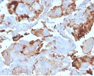 Formalin-fixed, paraffin-embedded human breast carcinoma stained with L-PLUNC Mouse Monoclonal Antibody (LPLUNC1/3206). HIER: Tris/EDTA, pH9.0, 45min. 2°C: HRP-polymer, 30min. DAB, 5min.