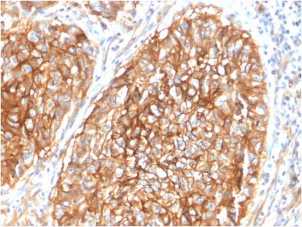 Formalin-fixed, paraffin-embedded human Lung Carcinoma stained with CD9 Mouse Monoclonal Antibody (CD9/1619).