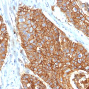 Formalin-fixed, paraffin-embedded human Cervical Carcinoma stained with CD9 Mouse Monoclonal Antibody (CD9/2343).