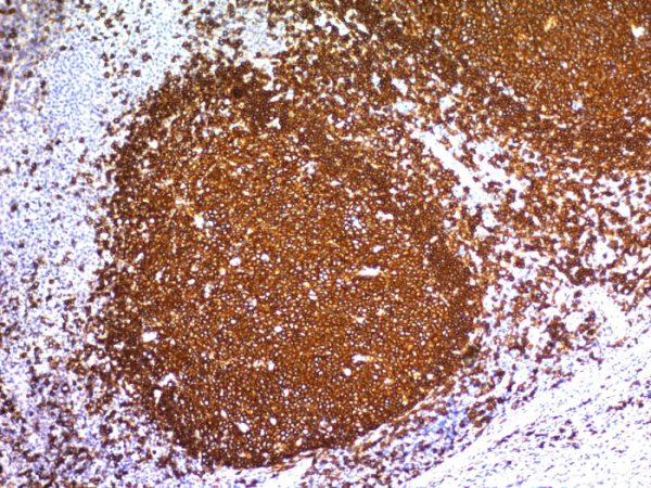 Formalin-fixed, paraffin-embedded human Tonsil stained with CD20 Mouse Monoclonal Antibody (L26).