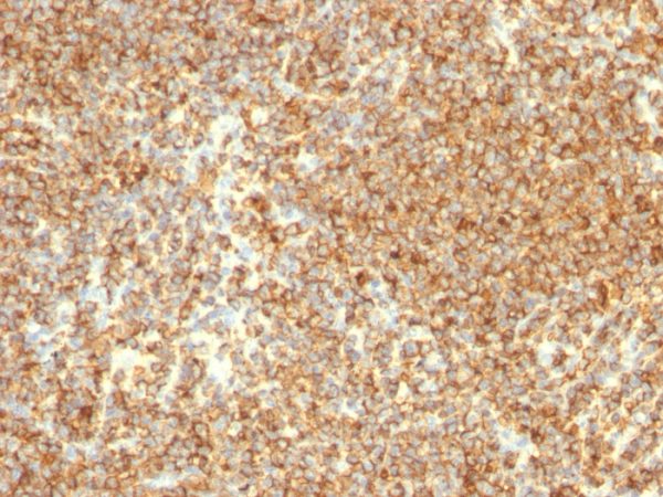Formalin-fixed, paraffin-embedded human Lymphoma stained with CD20 Mouse Monoclonal Antibody (L26).
