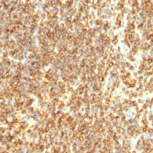 Formalin-fixed, paraffin-embedded human Lymphoma stained with CD20 Monoclonal Antibody (SPM494)