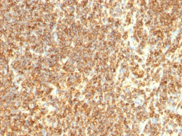 Formalin-fixed, paraffin-embedded human Lymphoma stained with CD20 Monoclonal Antibody (SPM494)