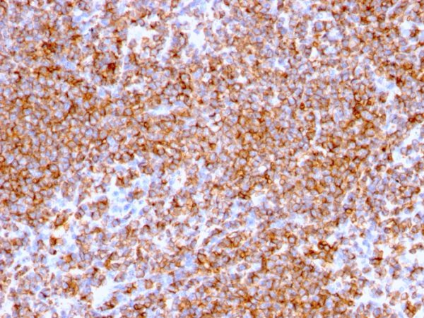 Formalin-fixed, paraffin-embedded human Lymphoma stained with CD20 Mouse Monoclonal Antibody (IGEL/773).