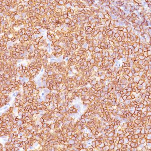 Formalin-fixed, paraffin-embedded human Tonsil stained with CD20 Monoclonal Antibody (SPM618)