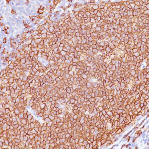 Formalin-fixed, paraffin-embedded human Tonsil stained with CD20 Monoclonal Antibody (L26 + IGEL/773)